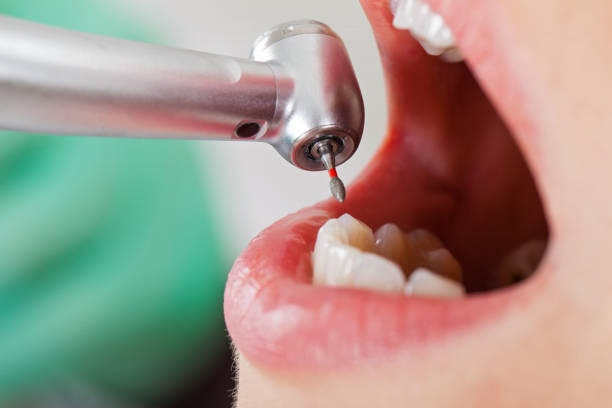 Best Emergency Wisdom Tooth Extraction in Flemington, GA